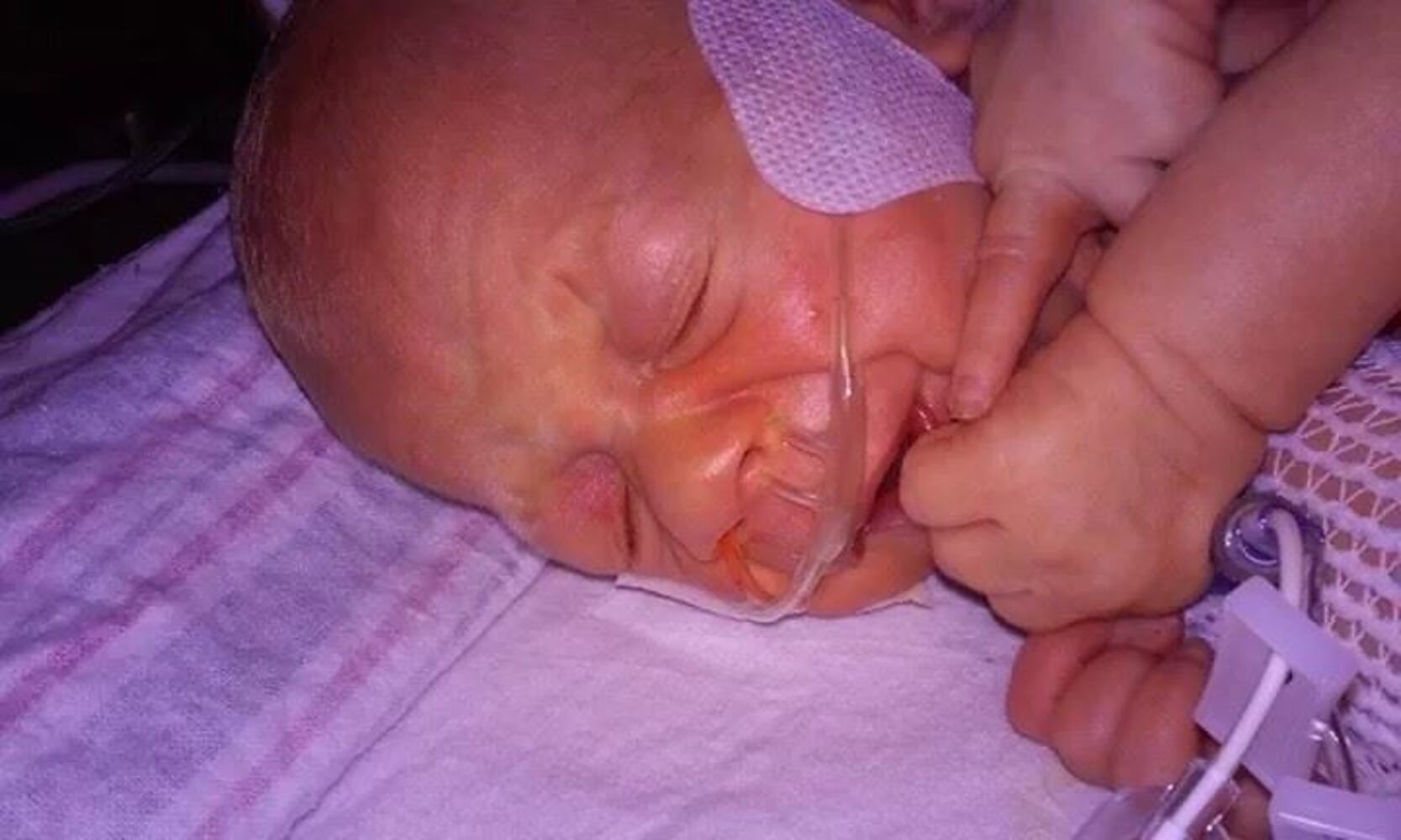 Conjoined twins Carter and Conner