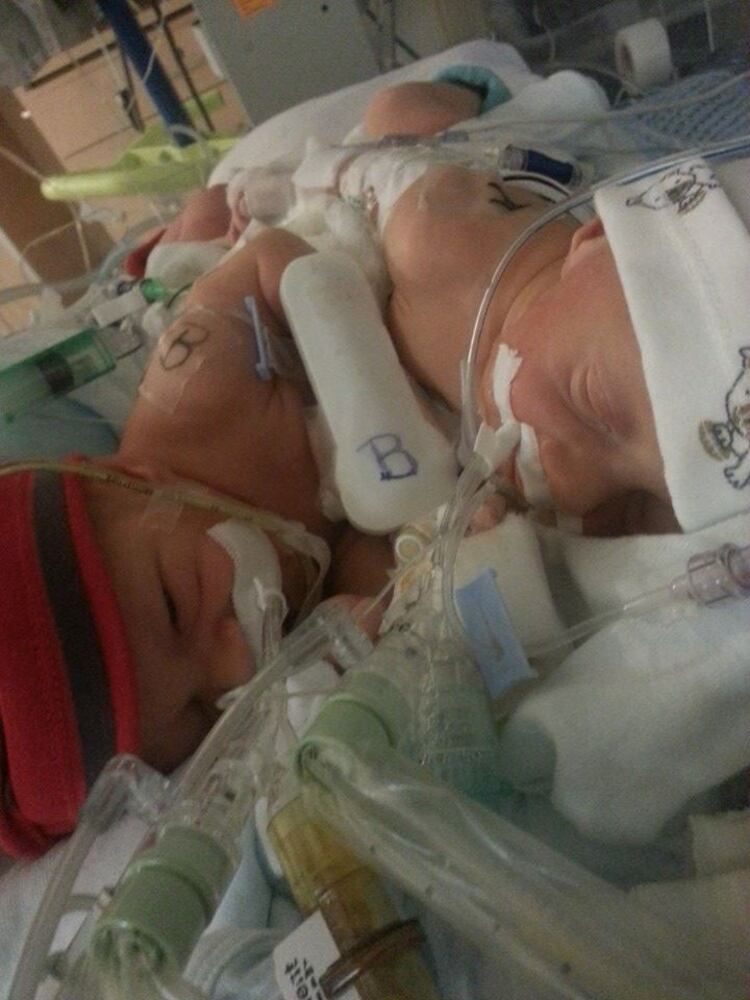 Conjoined twins born in Jacksonville
