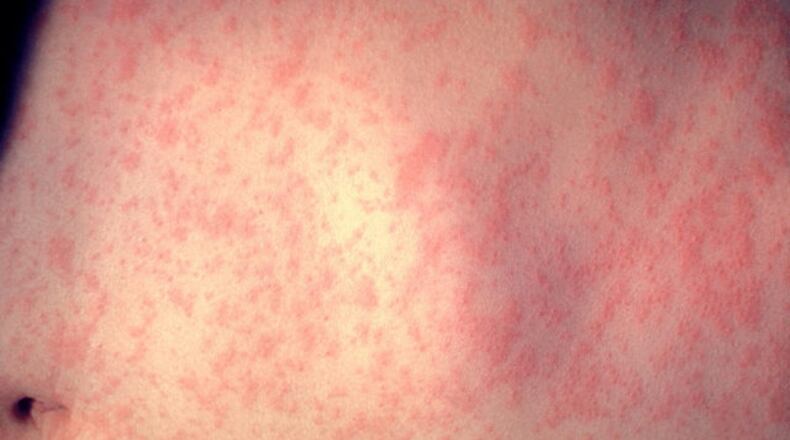 Measles case confirmed in metro Atlanta, officials say.