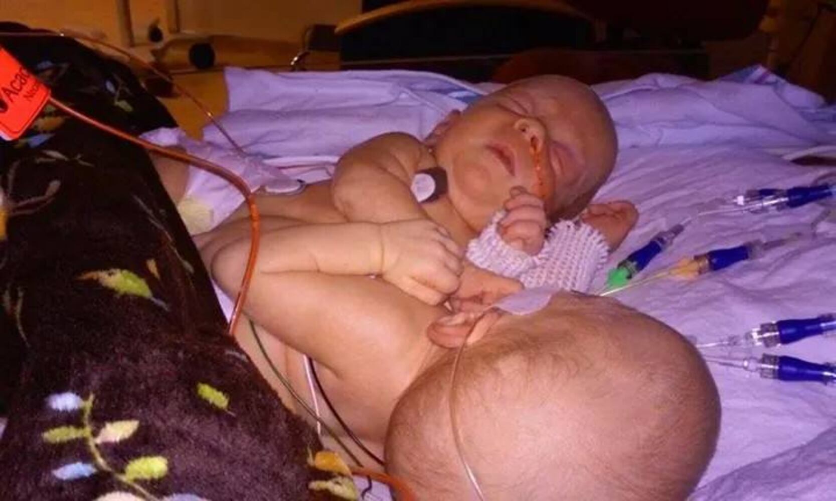 Conjoined twins Carter and Conner