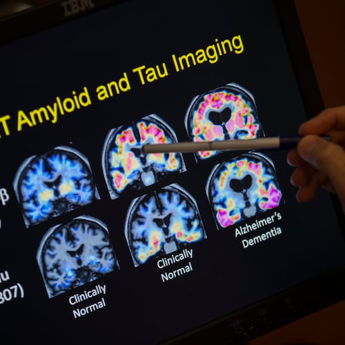 FILE - A doctor points to PET scan results that are part of a study on Alzheimer's disease at Georgetown University Hospital, on Tuesday, May 19, 2015, in Washington. (AP Photo/Evan Vucci, File)