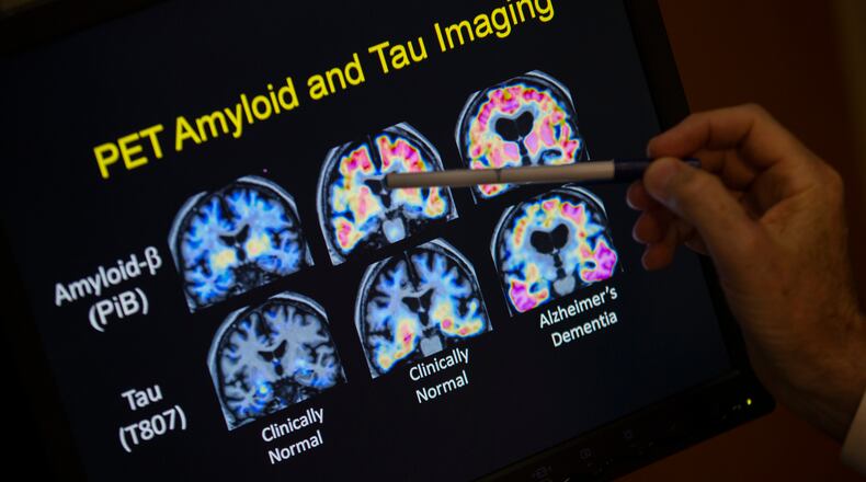 FILE - A doctor points to PET scan results that are part of a study on Alzheimer's disease at Georgetown University Hospital, on Tuesday, May 19, 2015, in Washington. (AP Photo/Evan Vucci, File)
