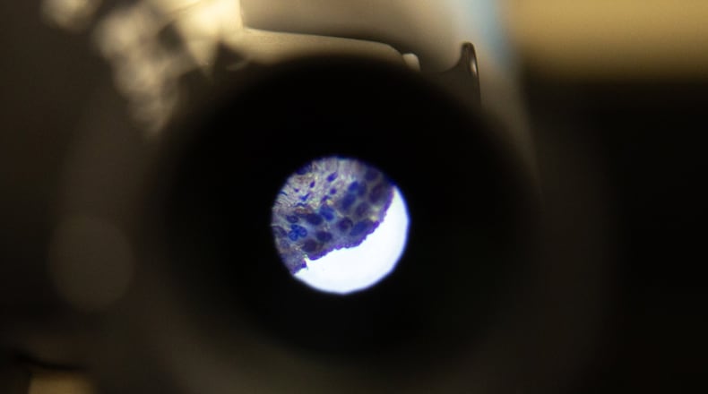 Magnified bladder tissue is seen through a microscope at a University of North Georgia lab in Oakwood. STEVE SCHAEFER / SPECIAL TO THE AJC