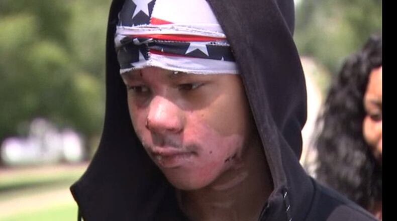 Malachi McFadden, 15, was badly burned during an experiment that went wrong in his high school chemistry class.