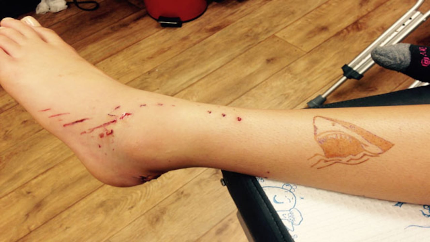 Photos: Seminole County girl bitten by shark