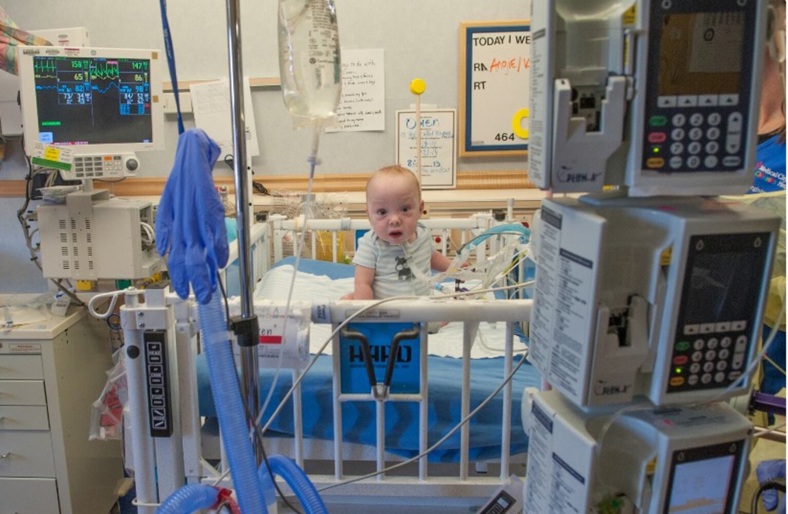 Separated conjoined twins released from Dallas hosptial