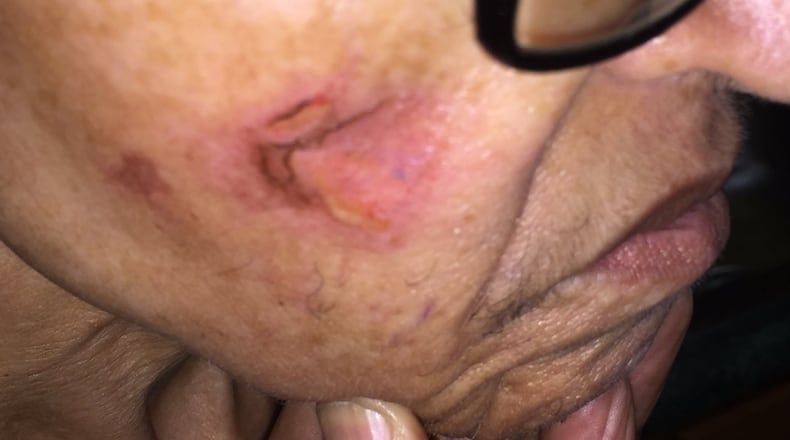 This is a picture of the burn on the face of Jacquelyn Stafford, a dementia patient who was spending a week at Hapeville Manor. In a lawsuit, her family alleges that a caregiver burned her repeatedly with a cigarette.