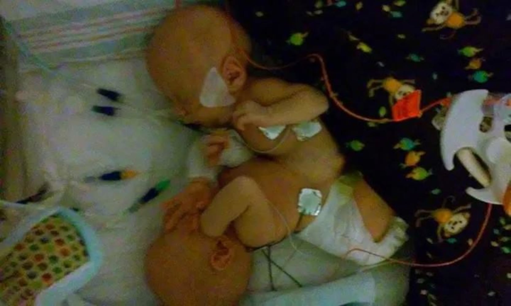 Conjoined twins Carter and Conner