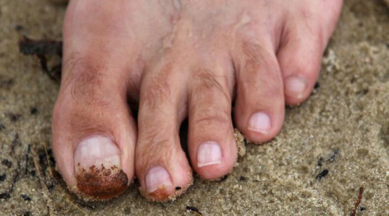 DAUPHIN ISLAND, AL - JUNE 02: Oil stains the big toe of William Barnett while he collects orange colored tar balls on a public beach on June 2, 2010 in Dauphin Island, Alabama. (Photo by Win McNamee/Getty Images)