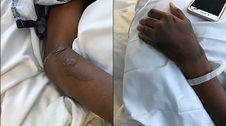 A 15-year-old DeKalb County high school student was burned Tuesday morning during a lab experiment in class.