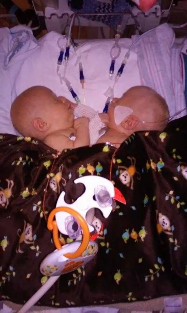 Conjoined twins Carter and Conner