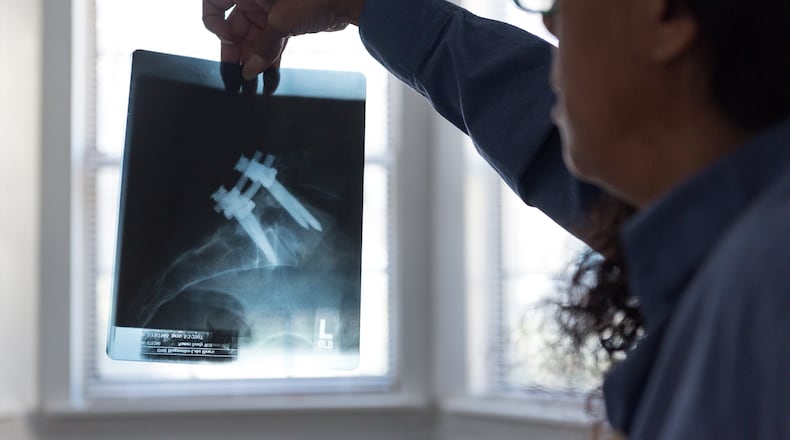 Cindy Wilburn, a former DeKalb County School District teacher, holds up x-ray photos of her first surgery to her spine after being pushed down bleachers by a student in 2001.