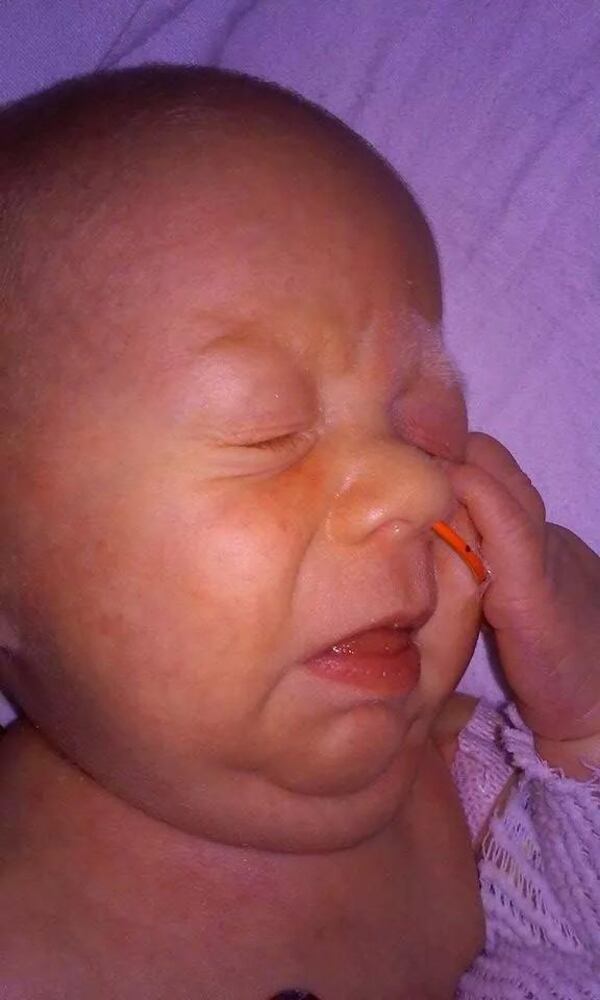 Conjoined twins Carter and Conner