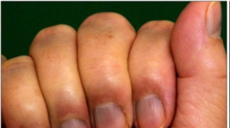 Federal authorities say that ingesting colloidal silver can cause a condition known as argria, where the skin and nail become discolored a blue gray because of excess silver ions in the body. Photo from National Library of Medicine