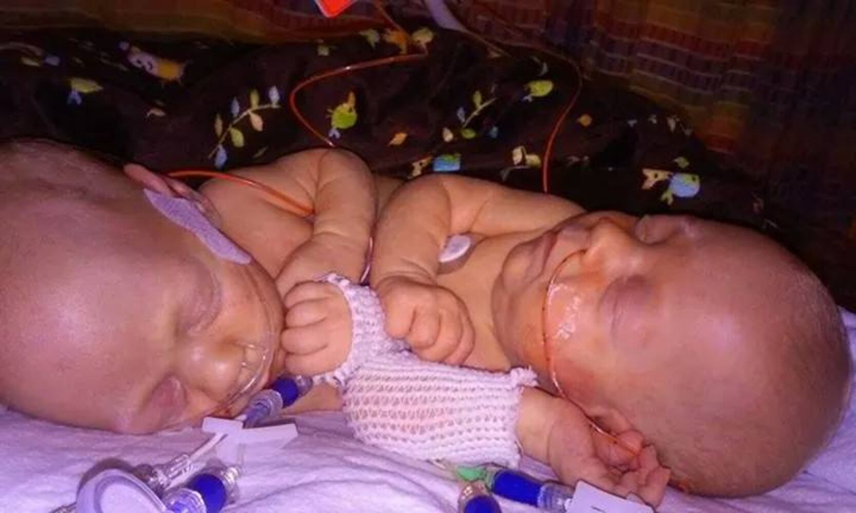 Conjoined twins Carter and Conner