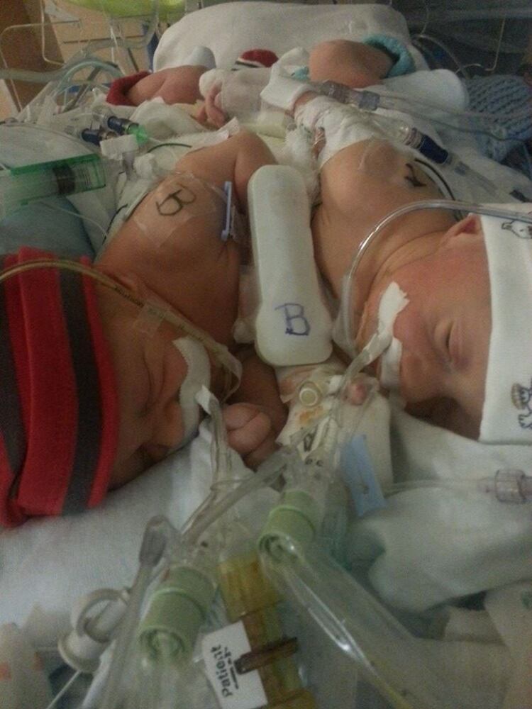 Conjoined twins born in Jacksonville