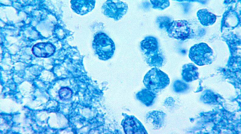 Naegleria fowleri (brain eating ameba)