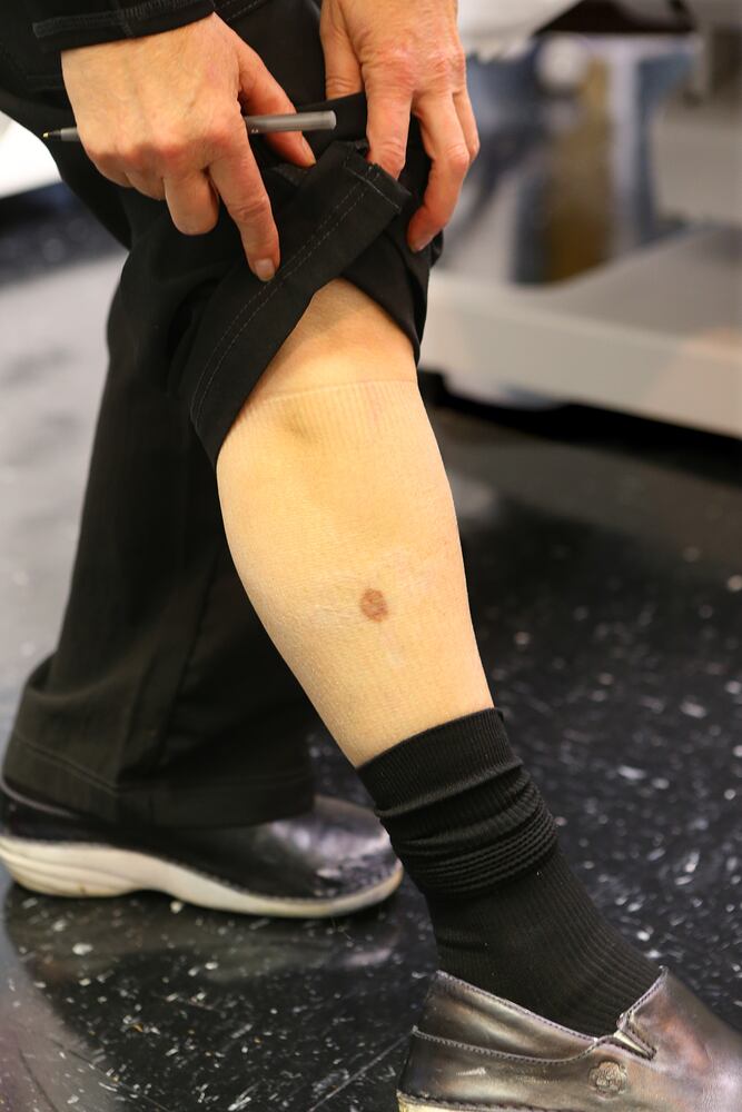 Tattoo removal Atlanta