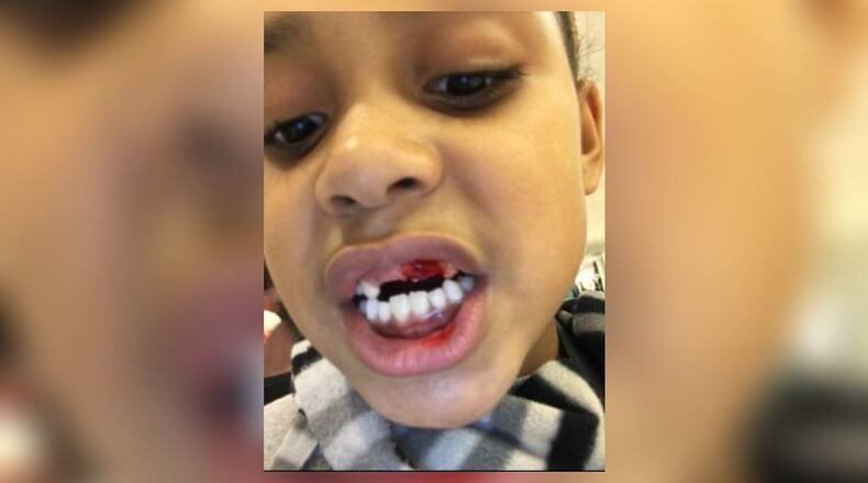 Sasha Miller, 7, was allegedly punched by a boy in her second-grade class. (Credit: Channel 2 Action News)