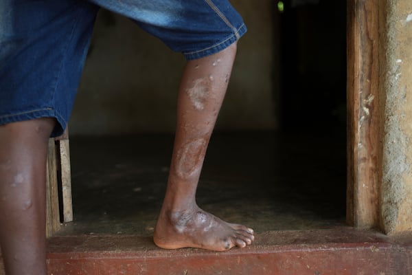 Scars from the wounds are seen on the legs of Vilvaraj Jethurshan, 16, who was injured in an explosion six years ago, as he stands at the doorway of his home in Mankindy, Sri Lanka, Tuesday, April 1, 2025. (AP Photo/Eranga Jayawardena)