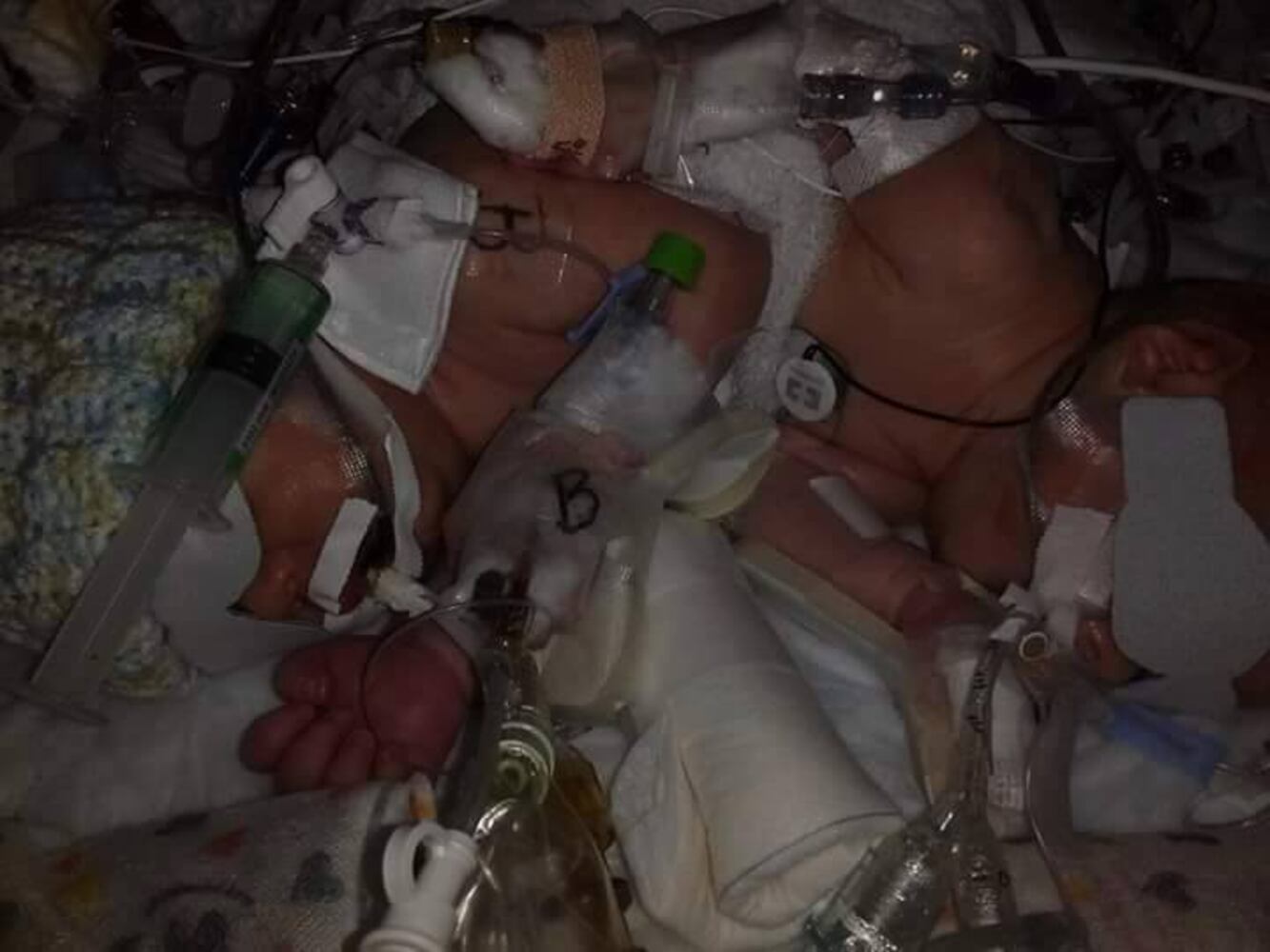 Conjoined twins born in Jacksonville