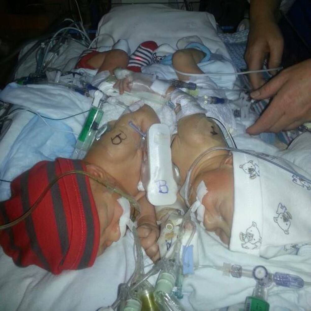 Conjoined twins born in Jacksonville