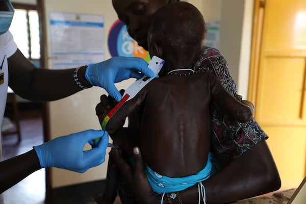 Sunday Achok, 14 months old, who suffers acute malnutrition and complications, is measured at the Ammusait General Hospital in Turkana, Kenya Wednesday, June 4, 2025. (AP Photo/Andrew Kasuku)