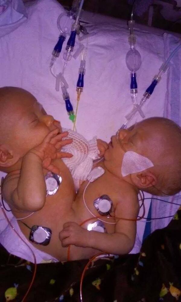 Conjoined twins Carter and Conner