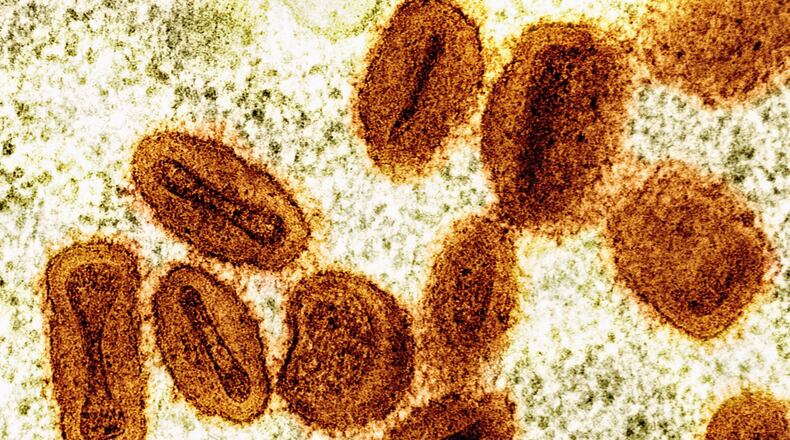 FILE - This colorized electron microscope image provided by the National Institute of Allergy and Infectious Diseases in 2024 shows Mpox virus particles, orange, found within infected cells, green. (NIAID via AP, File)