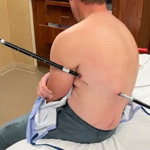 This photo provided by David Cifaldi shows Cifaldi while he was being treated Monday, July 20, 2026, at St. Vincent Regional Hospital in Billings, Mont. (Jessee Ross via AP)