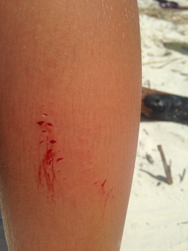 GRAPHIC WARNING: Shark bite at St. Helena Island