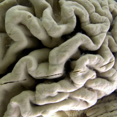 FILE - A human brain affected by Alzheimer's disease is displayed at the Museum of Neuroanatomy at the University at Buffalo in Buffalo, N.Y., on Oct. 7, 2003. (AP Photo/David Duprey, File)