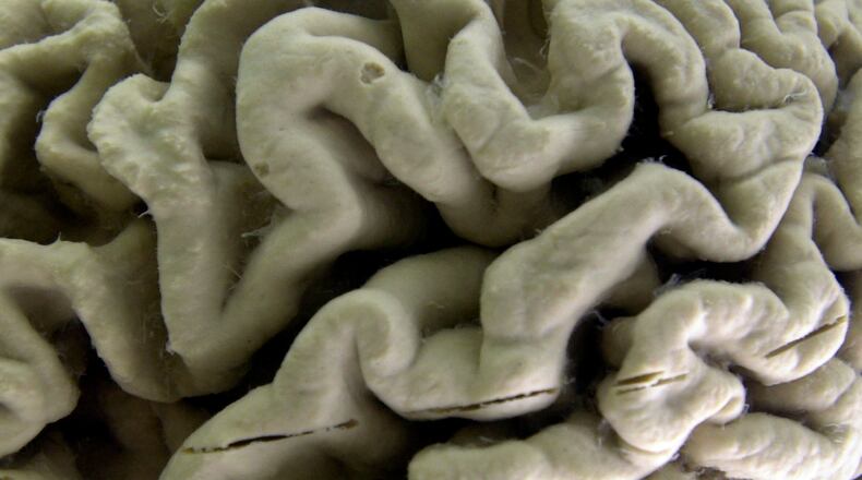 FILE - A human brain affected by Alzheimer's disease is displayed at the Museum of Neuroanatomy at the University at Buffalo in Buffalo, N.Y., on Oct. 7, 2003. (AP Photo/David Duprey, File)