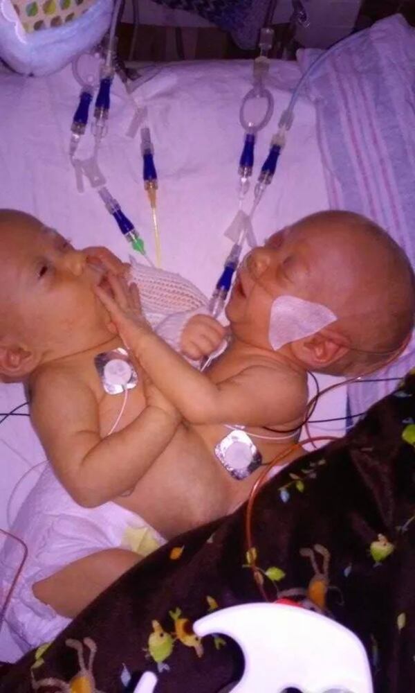 Conjoined twins Carter and Conner