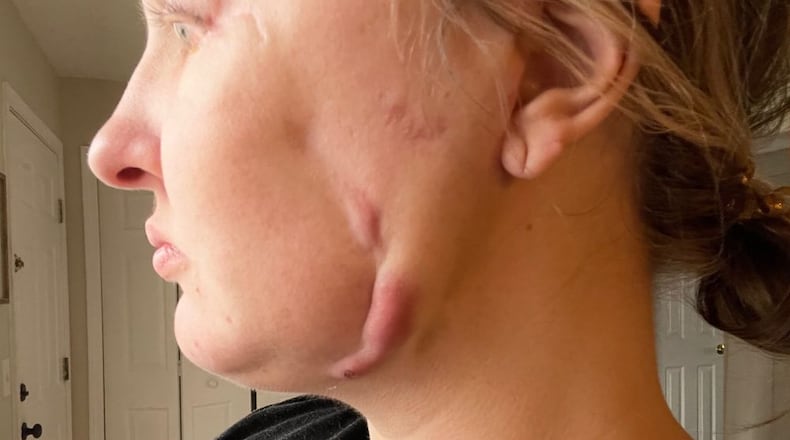 Kayla Cannon is one of 11 patients suing Atlanta cosmetic surgeon Harvey "Chip" Cole, alleging he left their faces permanently damaged and disfigured.