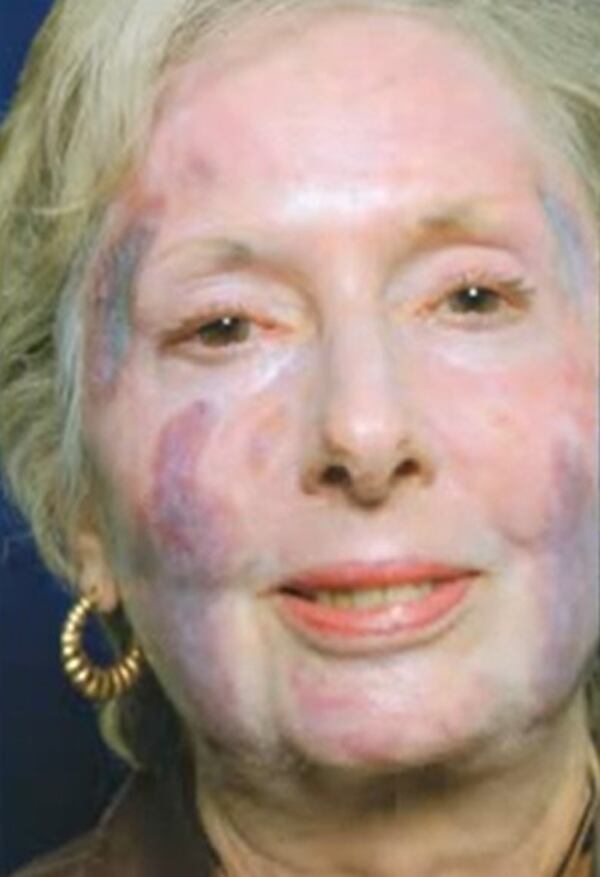 Marietta real estate agent Betty Nestlehutt was left with large permanent scars after undergoing surgery by Atlanta cosmetic surgeon Harvey "Chip" Cole in 2006. She won $1.2 million at trial against Cole.