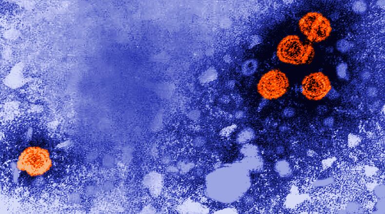 FILE - This 1981 electron microscope image made available by the U.S. Centers for Disease Control and Prevention shows hepatitis B virus particles, indicated in orange. (Dr. Erskine Palmer/CDC via AP, File)
