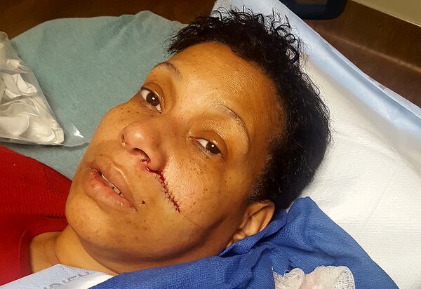 Zella Turner sustained broken bones and a laceration to her face as well as a broken finger when she said the brakes on a scooter failed on Jan. 24.