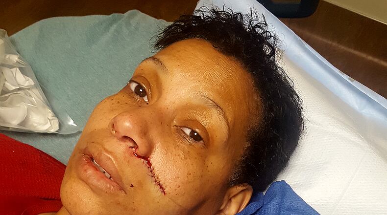 Zella Turner sustained broken bones and a laceration to her face as well as a broken finger when she said the brakes on a scooter failed on Jan. 24.