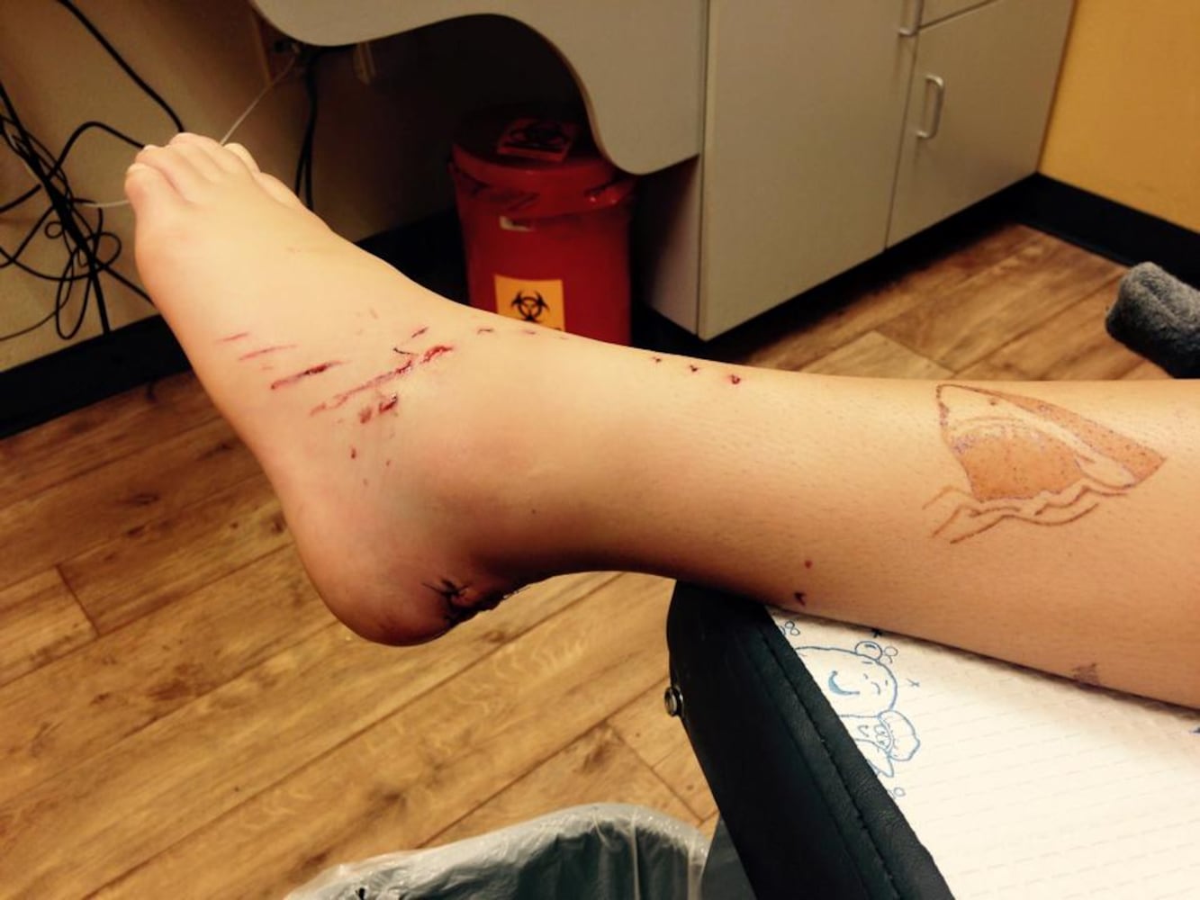 Photos: Seminole County girl bitten by shark