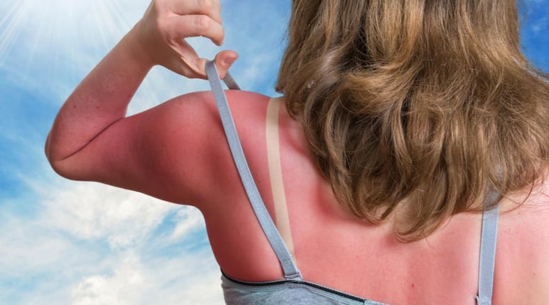 A mother from Texas says shaving cream can take the redness, sting from sunburn.