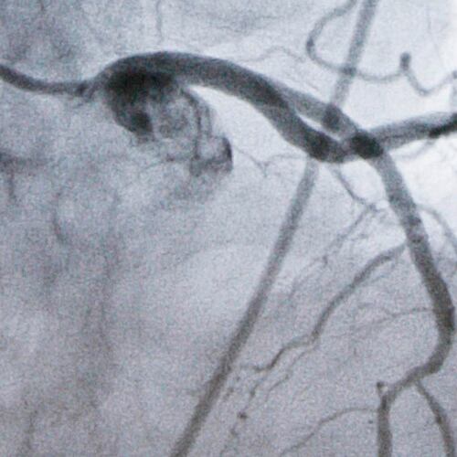 FILE - A monitor shows an artery during a catheterization lab heart procedure in Burlington, Vt., Tuesday, Sept. 23, 2008. (AP Photo/Toby Talbot, File)