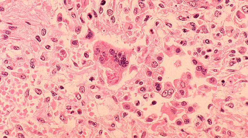 <p>Measles case </p>