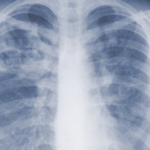 This 1967 chest x-ray photo provided by the U.S. Centers for Disease Control and Prevention shows pulmonary aspergillosis caused by a fungal organism of the genus Aspergillus. (CDC via AP)