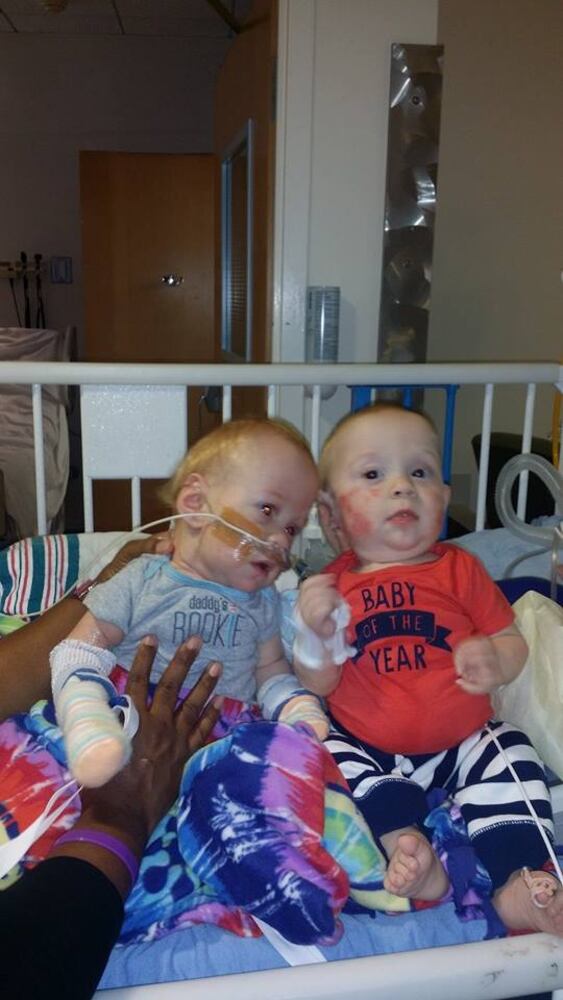 Formerly conjoined twins Carter and Conner