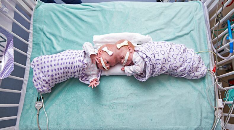 This September 2016 photo provided by the Children's Hospital of Philadelphia shows conjoined twin girls Abby Delaney, right, and Erin at the Children's Hospital of Philadelphia in Philadelphia. Hospital officials say surgeons successfully separated the 10-month-old twins June 6, 2017, during an 11-hour surgery. (Ed Cunicelli/Children's Hospital of Philadelphia via AP)