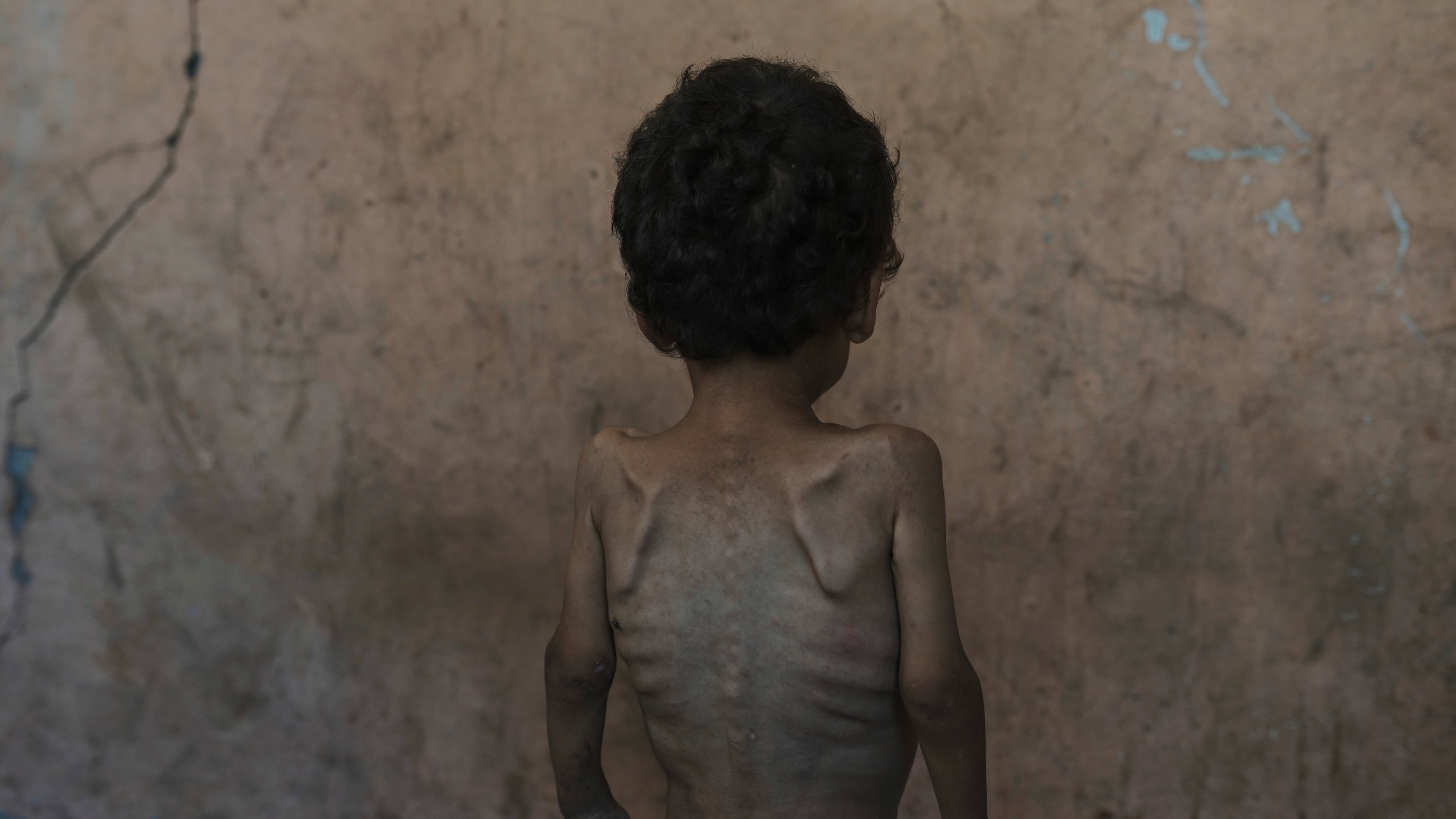 FILE.- Yazan Abu Ful, a 2-year-old malnourished child, poses for a photo at his family home in the Shati refugee camp, in Gaza City on Wednesday, July 23, 2025. (AP Photo/Jehad Alshrafi,File)