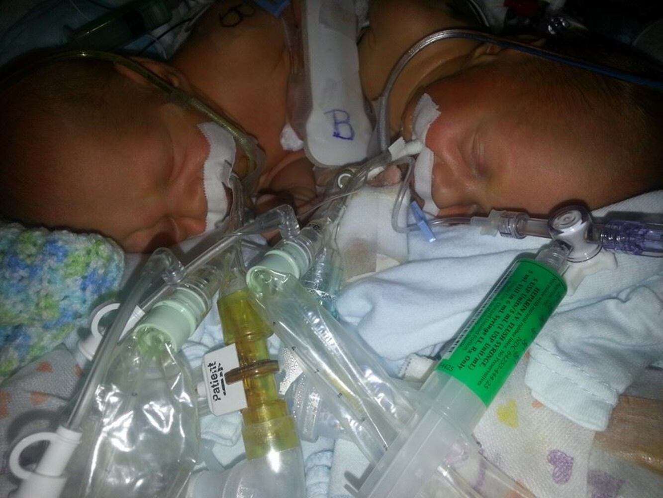 Conjoined twins born in Jacksonville