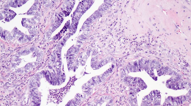 Cervical cancer cells