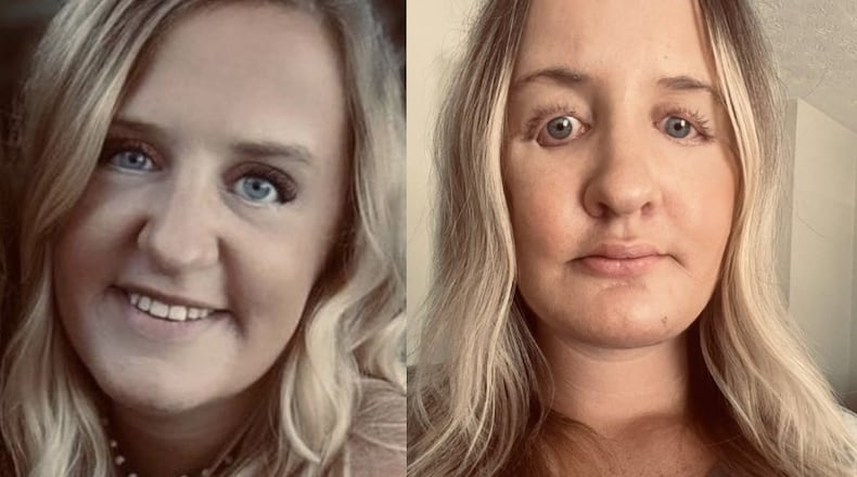 Kayla Cannon before (left) and after her surgeries by Atlanta cosmetic surgeon Harvey "Chip" Cole of Oculus Plastic Surgery. Cannon is one of four patients suing Cole and Oculus, claiming Cole permanently damaged and disfigured their faces. She gave permission for photographs of her face to be published. Courtesy